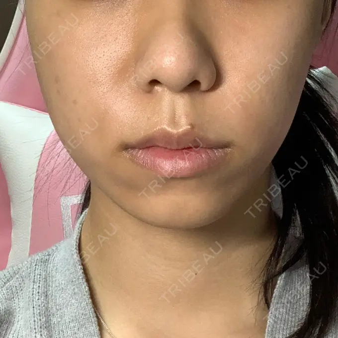 肌ヒアルロン酸注入（たるみ・シワ改善） / ボトックス（エラ・小顔） / その他（鼻） YBC横浜美容外科 大宮院 DAY 33 メイン用