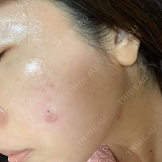 シミ取りレーザー / 光治療（フォトフェイシャルなど） 東京ミッドクリニック DAY 1 メイン用