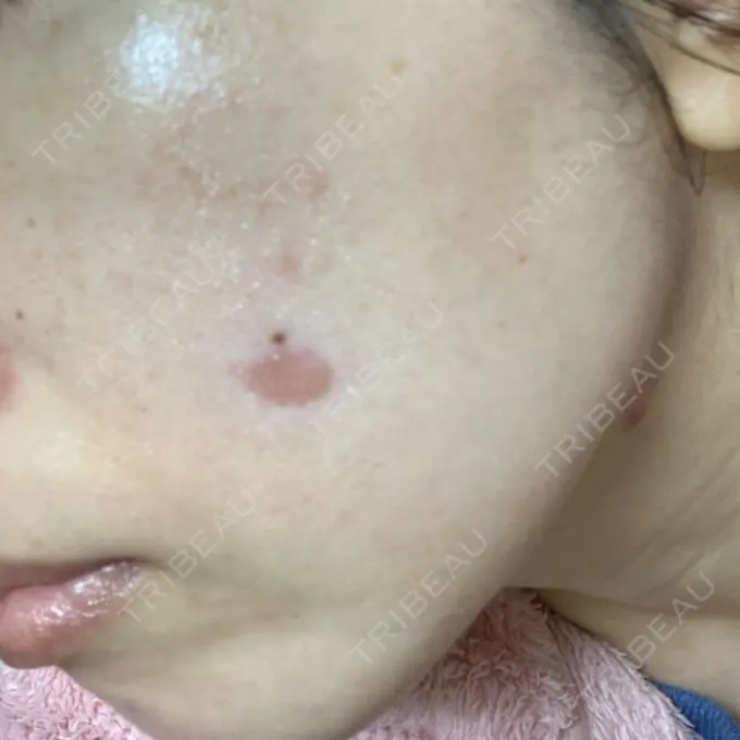 シミ取りレーザー / 光治療（フォトフェイシャルなど） 東京ミッドクリニック DAY 2 メイン用