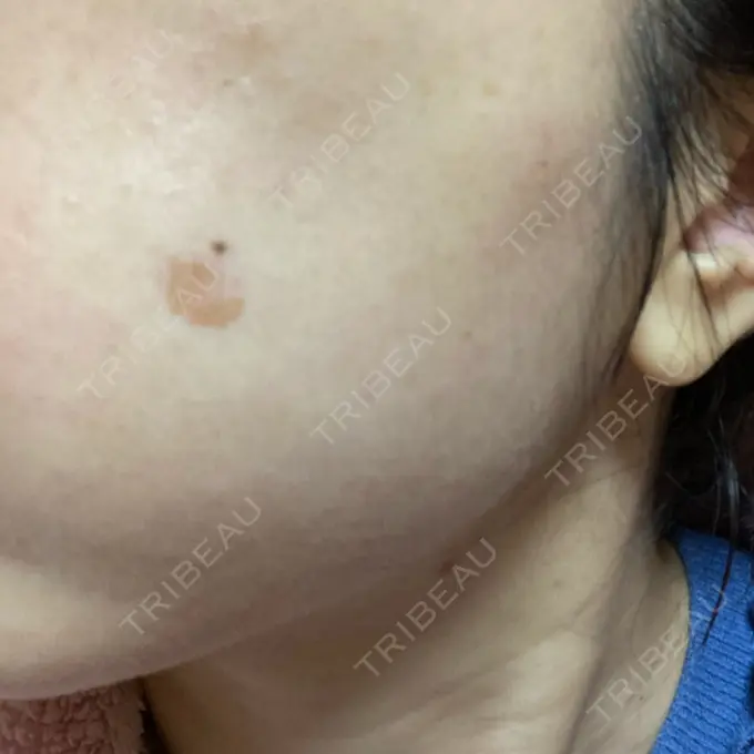 シミ取りレーザー / 光治療（フォトフェイシャルなど） 東京ミッドクリニック DAY 3 メイン用