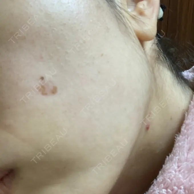 シミ取りレーザー / 光治療（フォトフェイシャルなど） 東京ミッドクリニック DAY 4 メイン用