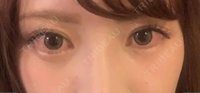 ヒアルロン酸注入（涙袋） / ボトックス（目尻） フィラークリニック 町田院 AFTER メイン用