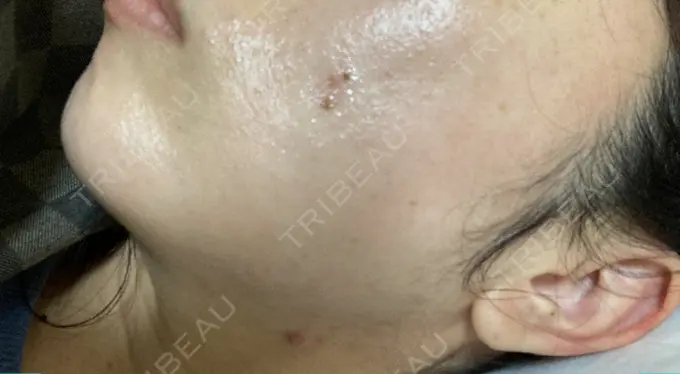 シミ取りレーザー / 光治療（フォトフェイシャルなど） 東京ミッドクリニック DAY 5 メイン用