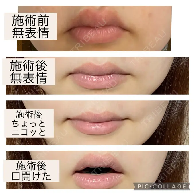 口角挙上 宇都宮竹内クリニック DAY 85 メイン用