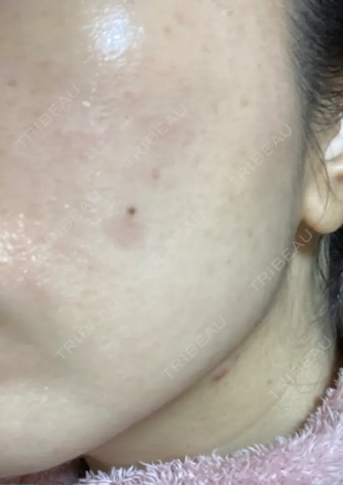 シミ取りレーザー / 光治療（フォトフェイシャルなど） 東京ミッドクリニック DAY 7 メイン用