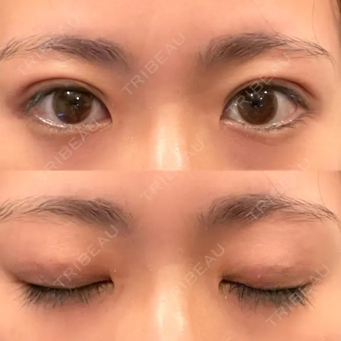 二重埋没 湘南メディカル記念病院（両国） DAY 23 メイン用