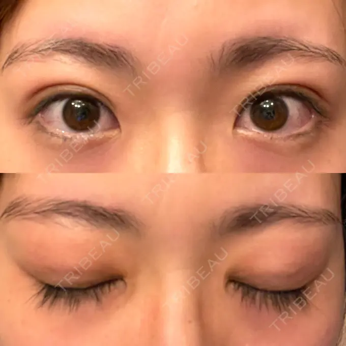 二重埋没 湘南メディカル記念病院（両国） DAY 27 メイン用