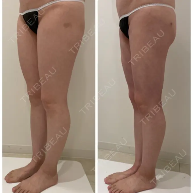 脂肪吸引（脚） / 脂肪吸引（お尻） / インディバ（お腹） 藤・ナチュレ美容クリニック 恵比寿院 DAY 28 メイン用