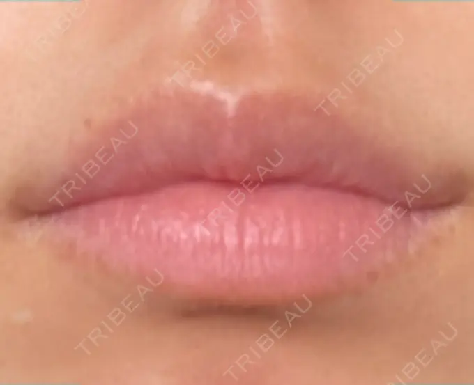 ヒアルロン酸注入（唇） / ボトックス（口角） フィラークリニック 名古屋栄院 AFTER メイン用