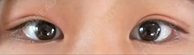 脂肪溶解注射（まぶた） 東京美容外科 銀座院 DAY 2 メイン用