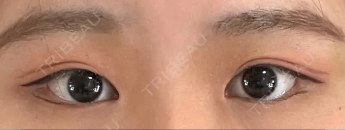 脂肪溶解注射（まぶた） 東京美容外科 銀座院 DAY 3 メイン用