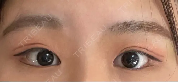 脂肪溶解注射（まぶた） 東京美容外科 銀座院 DAY 4 メイン用