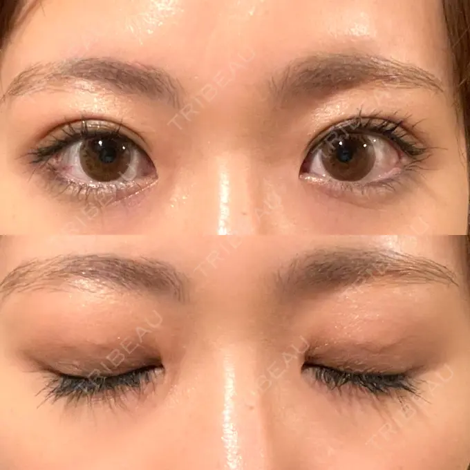 二重埋没 湘南メディカル記念病院（両国） DAY 28 メイン用