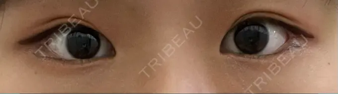 脂肪溶解注射（まぶた） 東京美容外科 銀座院 DAY 5 メイン用