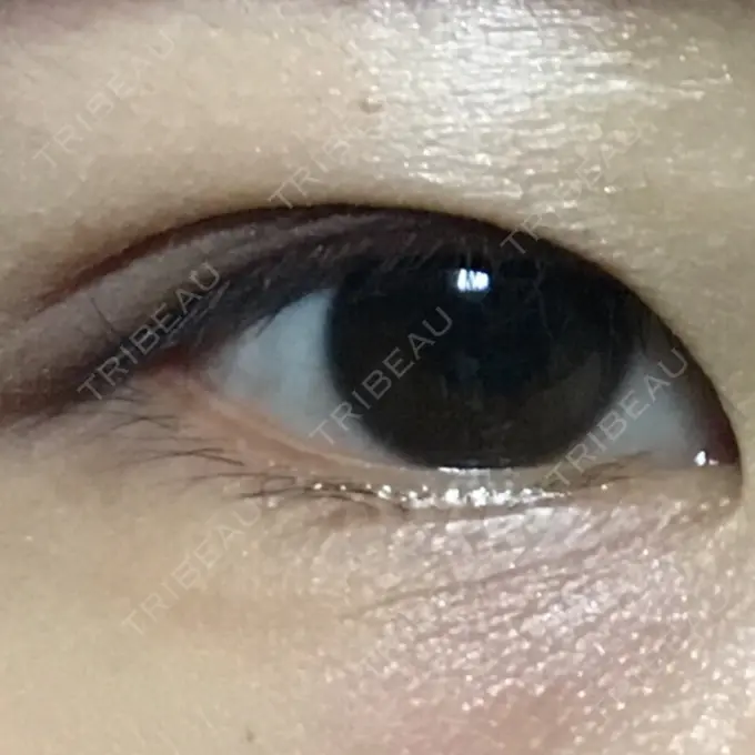 二重埋没 湘南美容クリニック 銀座院 DAY 122 メイン用