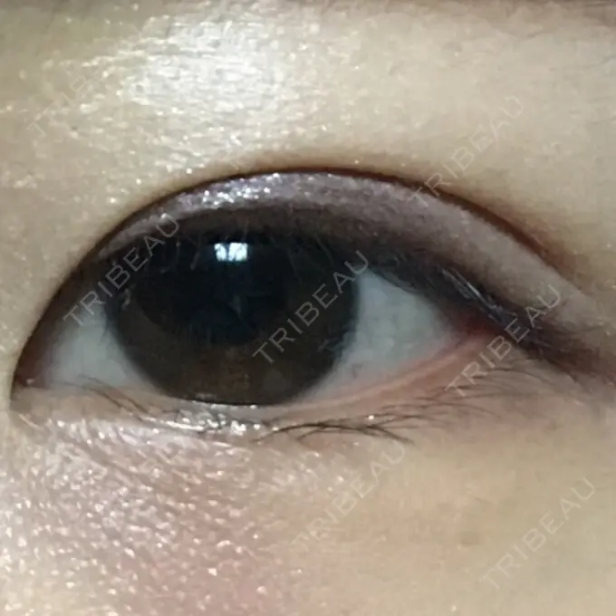 二重埋没 湘南美容クリニック 銀座院 DAY 122 メイン用