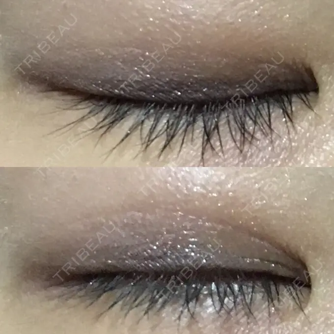 二重埋没 湘南美容クリニック 銀座院 DAY 122 メイン用