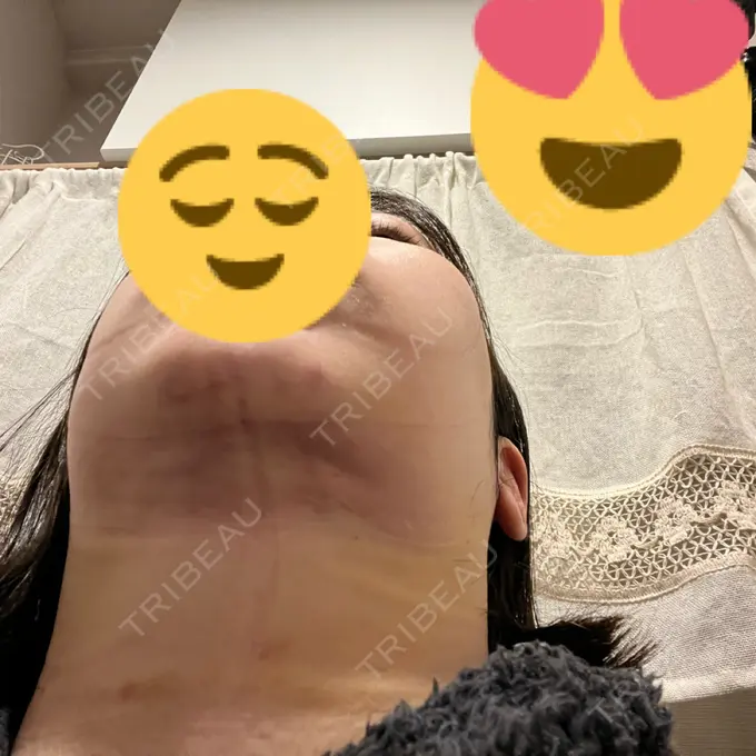 脂肪吸引（顔） みずほクリニック DAY 6 メイン用