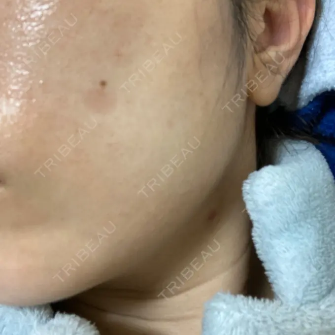 シミ取りレーザー / 光治療（フォトフェイシャルなど） 東京ミッドクリニック DAY 10 メイン用