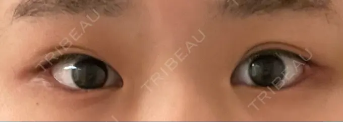 脂肪溶解注射（まぶた） 東京美容外科 銀座院 DAY 6 メイン用