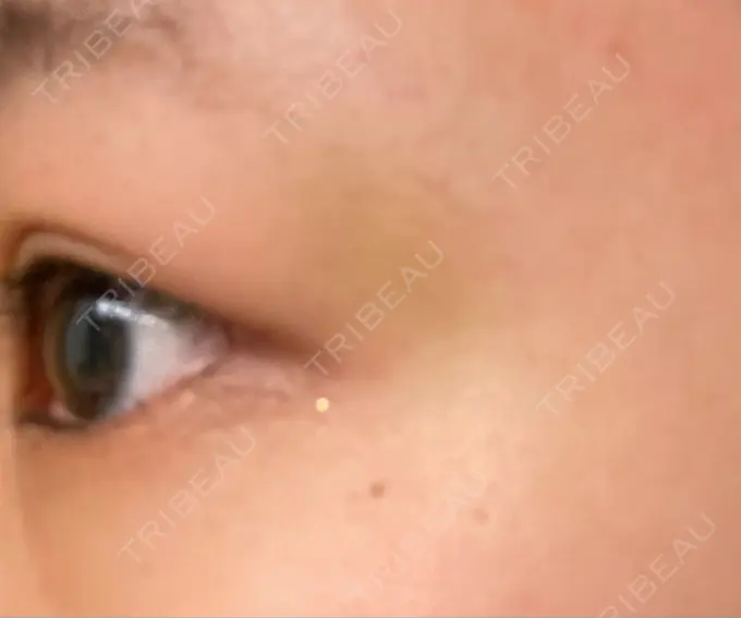 脂肪溶解注射（まぶた） 東京美容外科 銀座院 DAY 7 メイン用