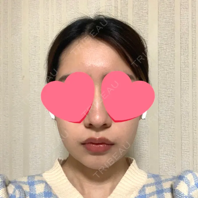 糸リフト / 脂肪吸引（顔） / メーラーファット除去 / ジョールファット除去 / ヒアルロン酸注入（頬） SEA CLINIC（シークリニック） DAY 34 メイン用