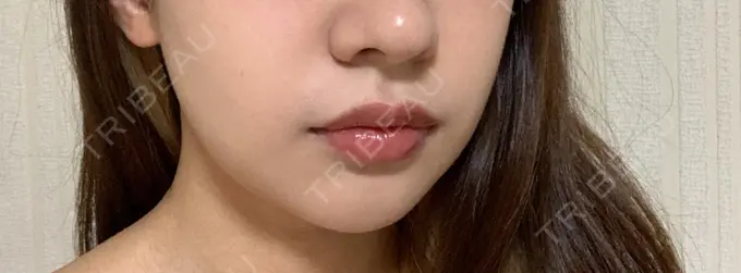 糸リフト / 脂肪吸引（顔） / メーラーファット除去 / ジョールファット除去 / ヒアルロン酸注入（頬） SEA CLINIC（シークリニック） DAY 34 メイン用