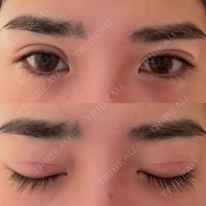 二重切開 高須クリニック 横浜院 DAY 53 メイン用