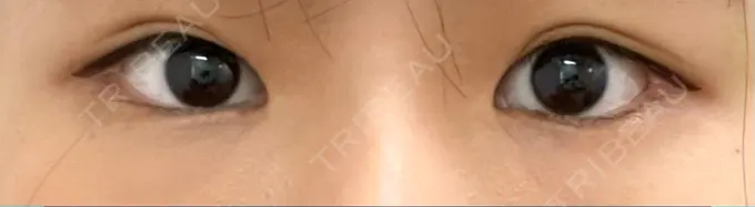 脂肪溶解注射（まぶた） 東京美容外科 銀座院 DAY 8 メイン用