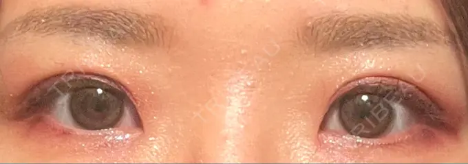 二重埋没 東京BELLEZZAクリニック DAY 196 メイン用