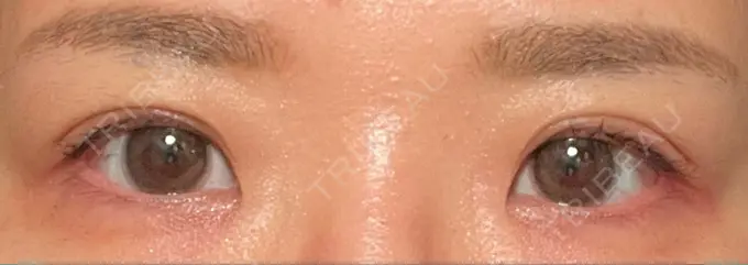 二重埋没 東京BELLEZZAクリニック DAY 196 メイン用