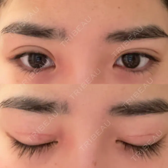 二重切開 高須クリニック 横浜院 DAY 54 メイン用