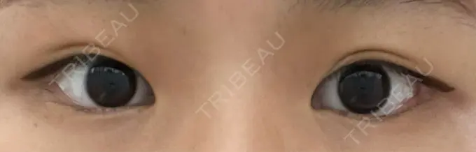 脂肪溶解注射（まぶた） 東京美容外科 銀座院 AFTER メイン用