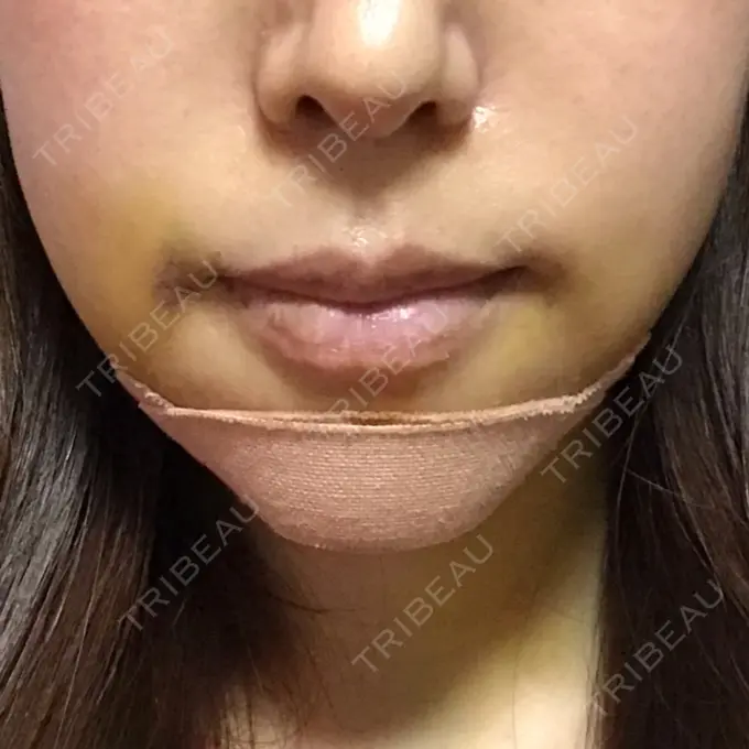 あごプロテーゼ / 骨切り（あご） ジョウクリニック 大阪院 DAY 5 メイン用