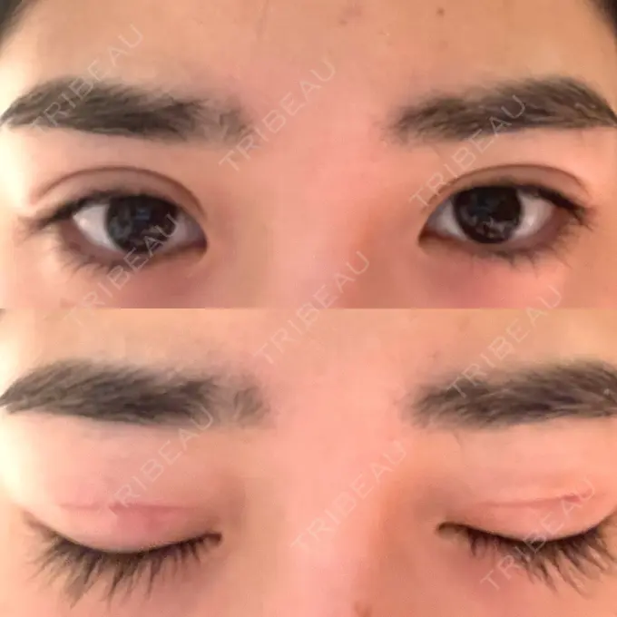 二重切開 高須クリニック 横浜院 DAY 55 メイン用