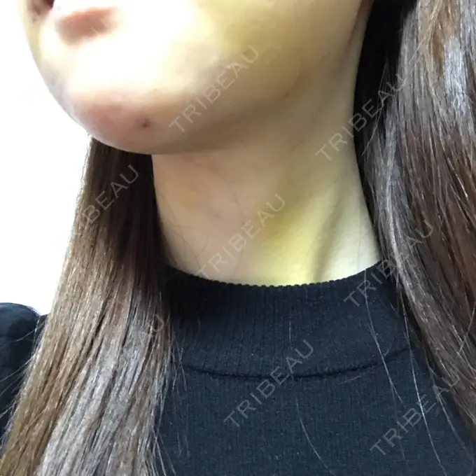 あごプロテーゼ / 骨切り（あご） ジョウクリニック 大阪院 DAY 7 メイン用