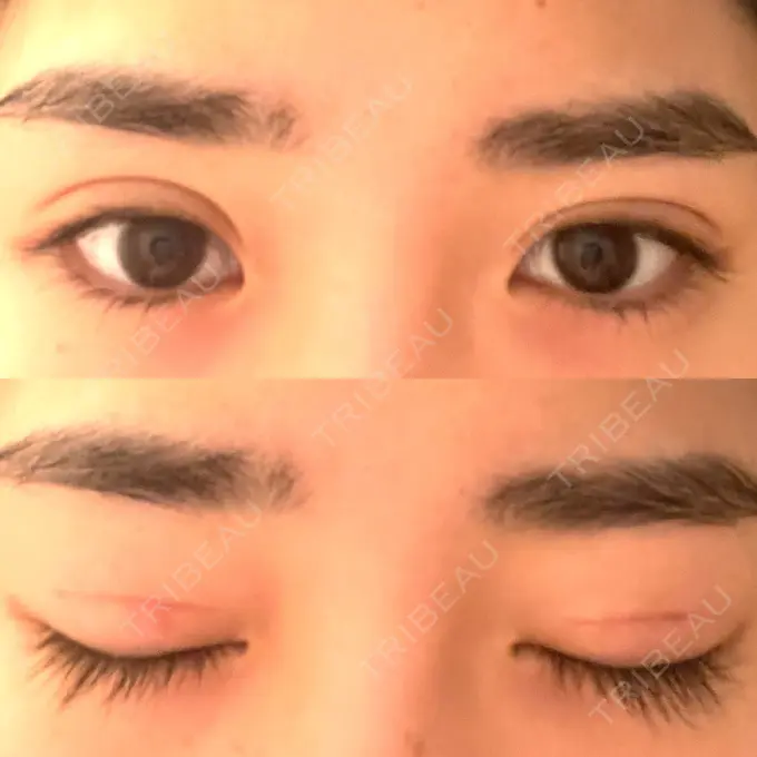 二重切開 高須クリニック 横浜院 DAY 56 メイン用