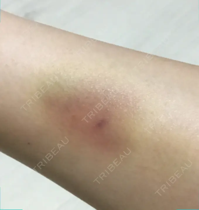 脂肪吸引（お腹） / インディバ（お腹） 藤・ナチュレ美容クリニック 恵比寿院 DAY 8 メイン用