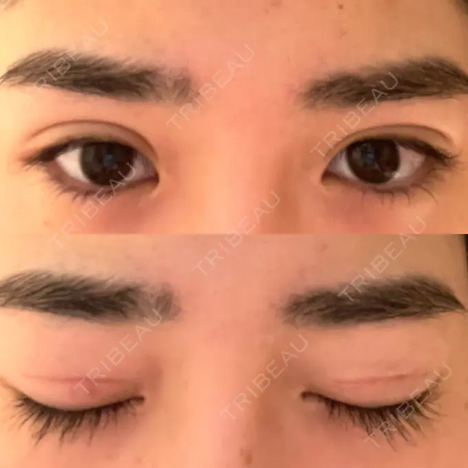 二重切開 高須クリニック 横浜院 DAY 57 メイン用