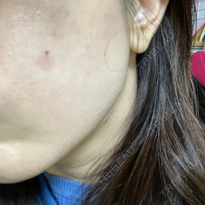 シミ取りレーザー / 光治療（フォトフェイシャルなど） 東京ミッドクリニック AFTER メイン用