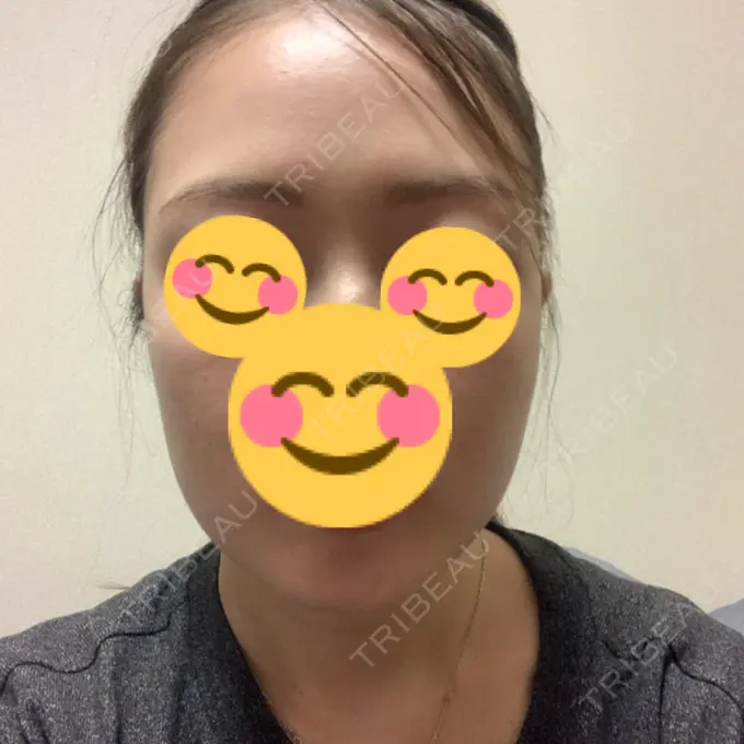 糸リフト / 脂肪吸引（顔） / メーラーファット除去 / ボトックス（エラ・小顔） 湘南美容クリニック 秋葉原院 DAY 15 メイン用