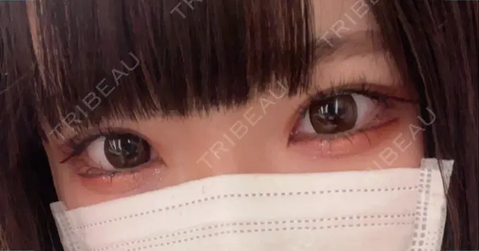 二重埋没 湘南メディカル記念病院（両国） AFTER メイン用