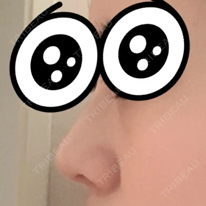 軟骨移植 GLANZ CLINIC DAY 31 メイン用