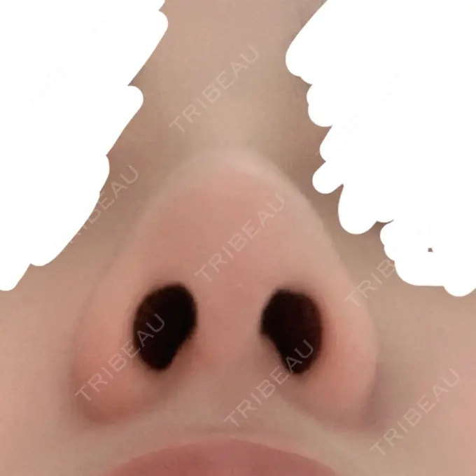 軟骨移植 GLANZ CLINIC DAY 31 メイン用