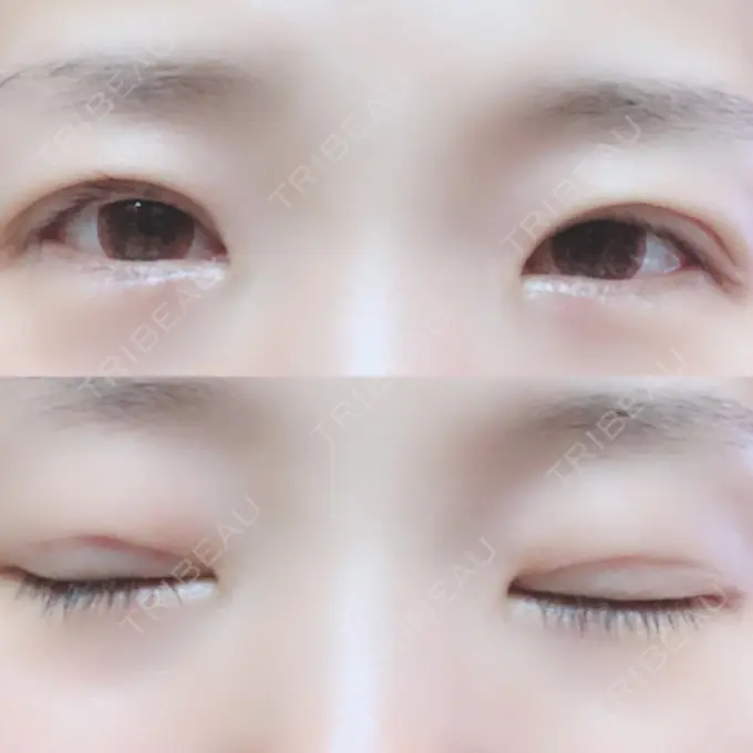 二重埋没 湘南美容クリニック 長野院 DAY 15 メイン用