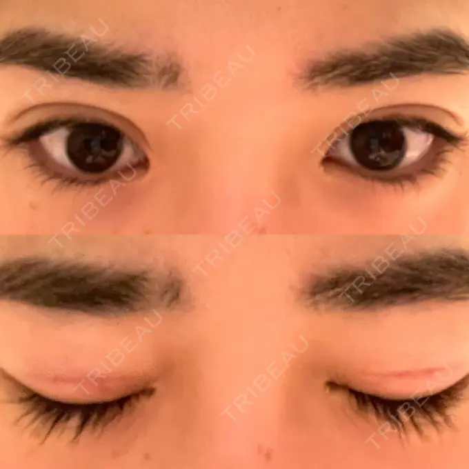 二重切開 高須クリニック 横浜院 DAY 58 メイン用