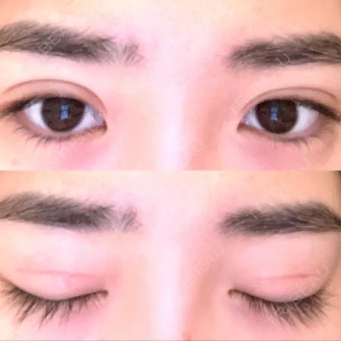 二重切開 高須クリニック 横浜院 DAY 59 メイン用