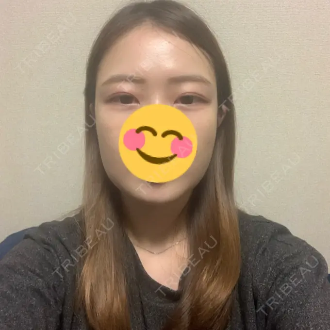 糸リフト / 脂肪吸引（顔） / メーラーファット除去 / ボトックス（エラ・小顔） 湘南美容クリニック 秋葉原院 DAY 18 メイン用