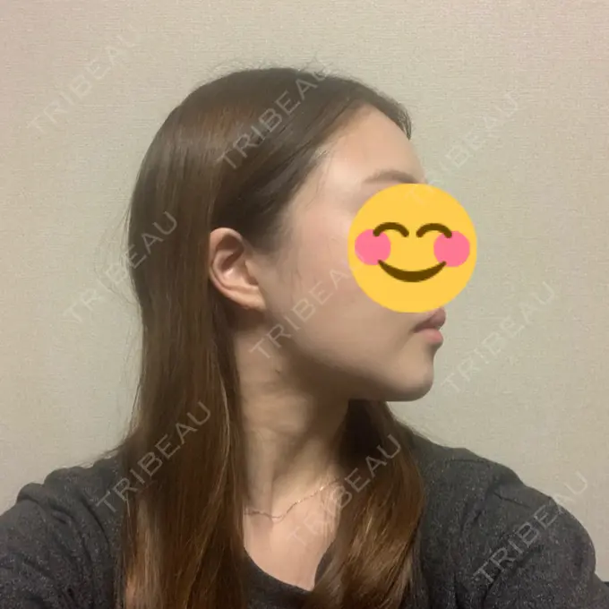 糸リフト / 脂肪吸引（顔） / メーラーファット除去 / ボトックス（エラ・小顔） 湘南美容クリニック 秋葉原院 DAY 18 メイン用