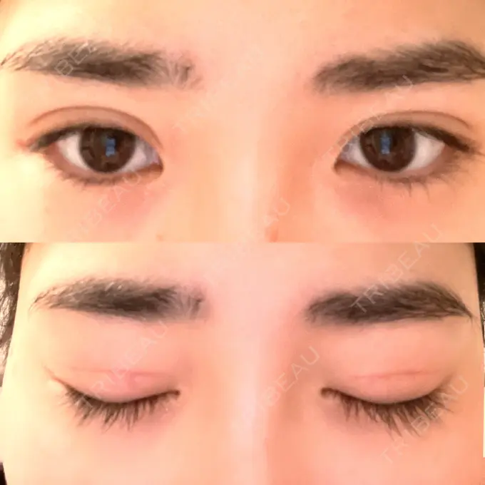 二重切開 高須クリニック 横浜院 DAY 60 メイン用